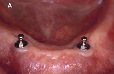 LOWER IMPLANT DENTURE- DESIGN 2