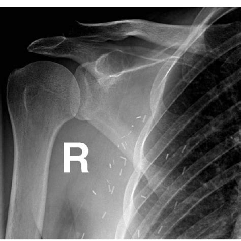 AP radiograph of the nondisplaced pathologic coracoid process fracture. | Download Scientific ...