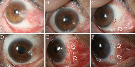 a: Thick and fleshy primary pterygium (S 4 V 3 C 4 K 3 ) is observed... | Download Scientific ...