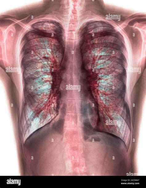 Coloured chest X-ray (front view) showing mucus in the lungs in a 28 ...