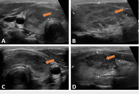 Thyroid ultrasound (US) showing heterogeneous diffuse goiter without ...