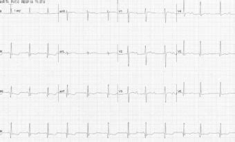 Hypokalaemia ECG changes • LITFL • ECG Library