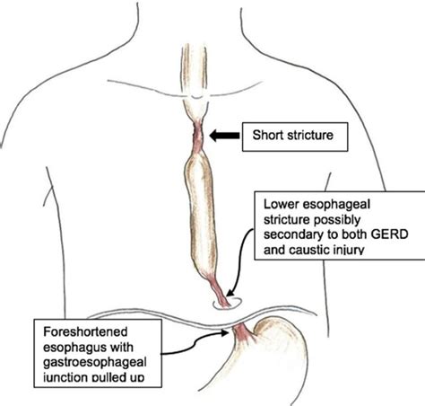 Esophageal Stricture | Medical Junction