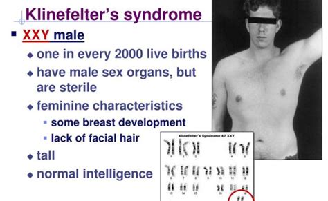 Difference Between Turner Syndrome And Klinefelter Syndrome – Otosection