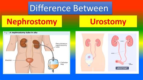 A Quick Guide To Urostomy Basics United Ostomy Associations, 51% OFF