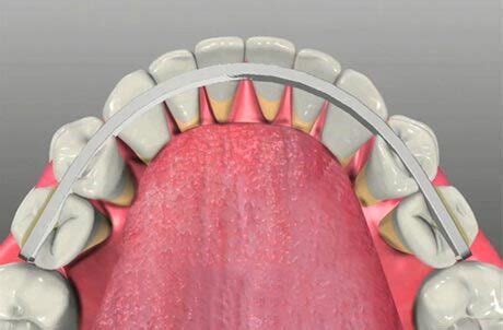 Dental Splint for Loose Teeth. How It Works and Which to Choose ...