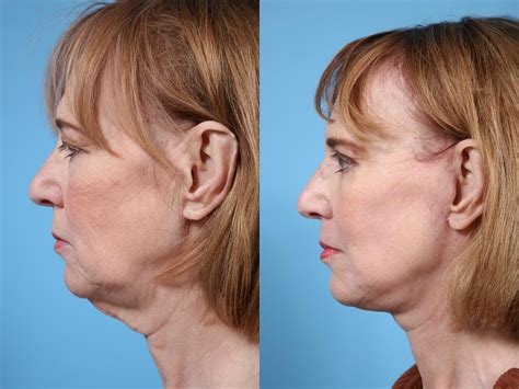 Neck Lift Before & After Photos Patient 68 | Chicago, IL | TLKM Plastic Surgery