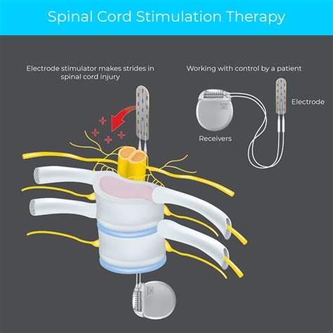 Spinal Cord Stimulator | AVALA Pain