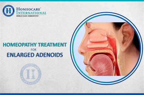 Role of Constitutional Homeopathy for Enlarged Adenoids