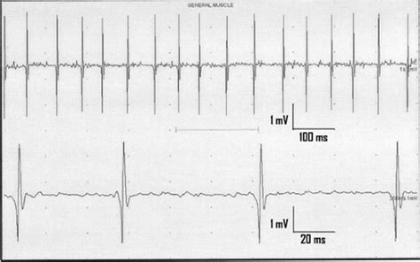 The Essentials of the Needle EMG Exam | Neupsy Key