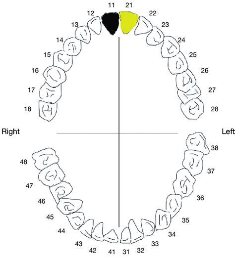 Dental chart showing the location of the teeth. The black is the missed... | Download Scientific ...