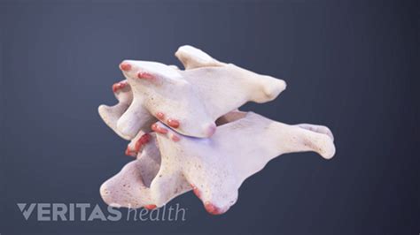 Cervical Osteophytes: Bone Spurs in the Neck