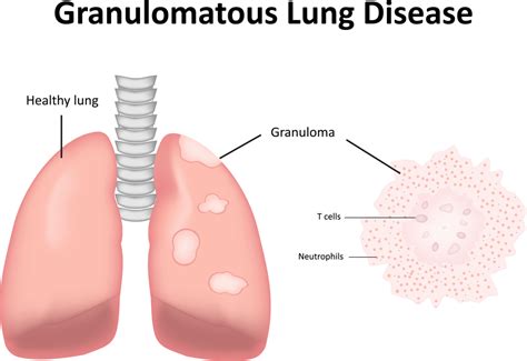 Granulomatosis With Polyangiitis Symptoms and Causes - Facty Health