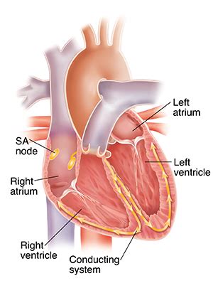 Understanding Premature Ventricular Contractions (PVCs) | Saint Luke's ...