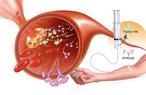 Clinical Management of Inhibitors in Children With Hemophilia ...