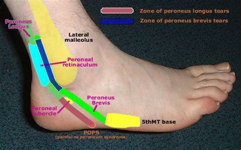 Pin on Peroneal Tendon