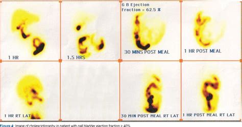 Figure 2 from Role of cholescintigraphy in management of acute ...