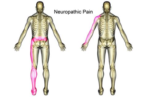 Neuropathic Pain Symptoms & Treatment