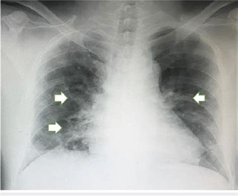 Chest Radiograph Ground Glass