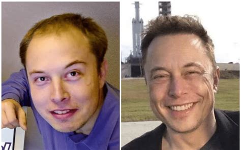 Elon musk hair transplant - Medousa Clinique