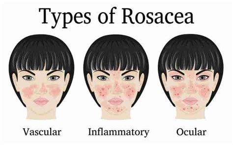 What Causes Rosacea? | Infographics Archive