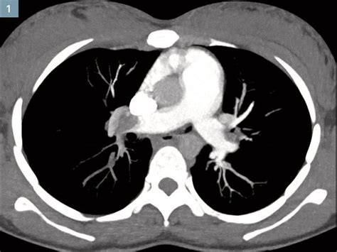 Pulmonary Embolism Diagnosis in Pregnancy: How Bicêtre Hospital Overcomes Imaging Challenges ...