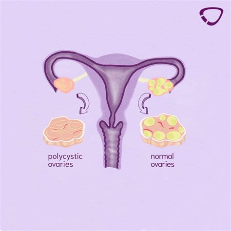 How Can I Detect PCOS? - cyclotest.de