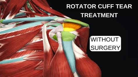 Rotator Cuff Tear Treatment Exercises