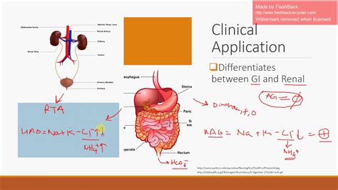 Urine Anion Gap - YouTube