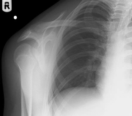 Lightbulb sign (shoulder dislocation) | Radiology Reference Article ...