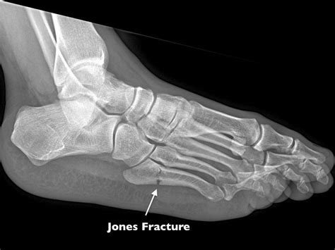 What Exactly is a Jones Fracture (Foot) and Why Might it Need Surgery?