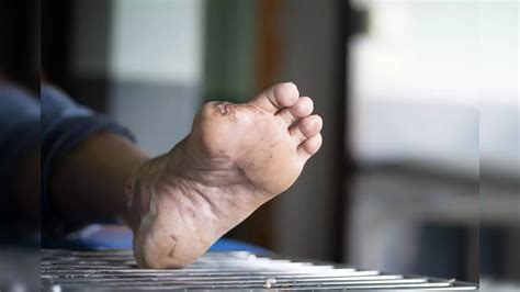 Diabetics beware! Check for gangrene before it leads to amputation | Health News, Times Now