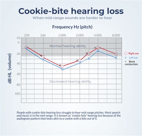 What is cookie bite hearing loss – Artofit