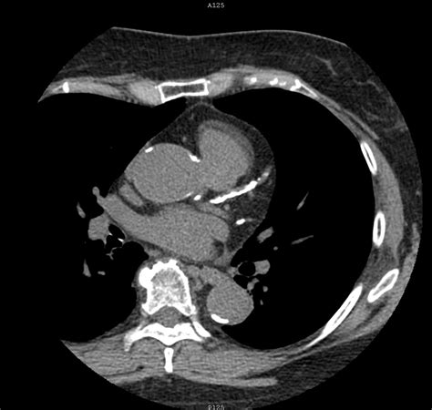 28+ Ct Cardiac Calcium Score Test PNG