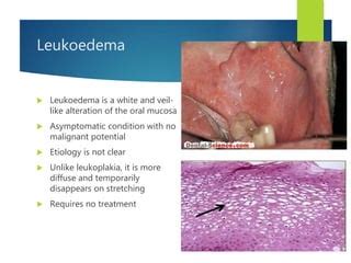 Leukoedema Histology