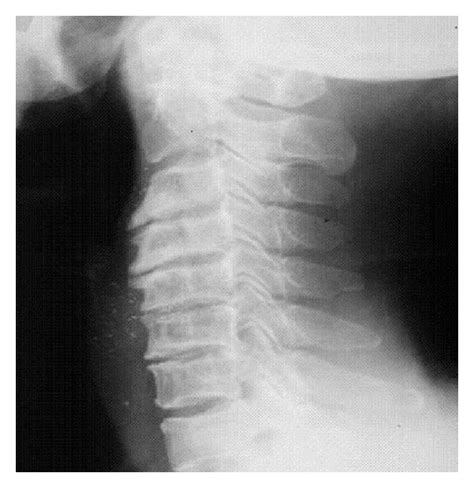 Cervical Spondylosis X Ray Findings