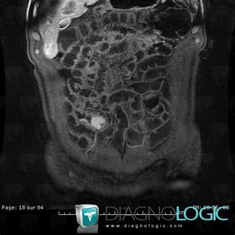 Radiology case : Islet cell tumor (MRI) - Diagnologic