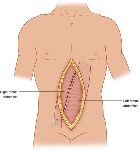 Midline Abdominal Wall Gaps and Incisional Hernia | Oncohema Key