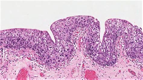 Urothelial carcinoma in situ (CIS) | MyPathologyReport.ca