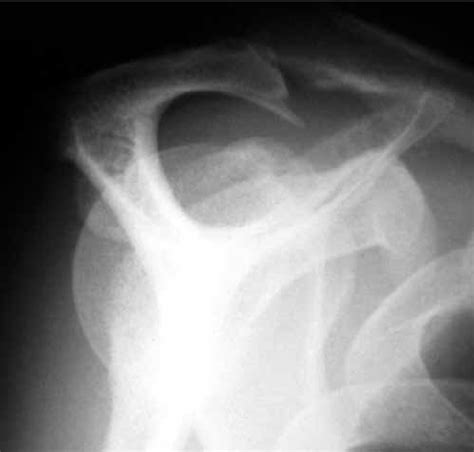 Plain radiograph of a type III acromion with a prominent acromial... | Download Scientific Diagram