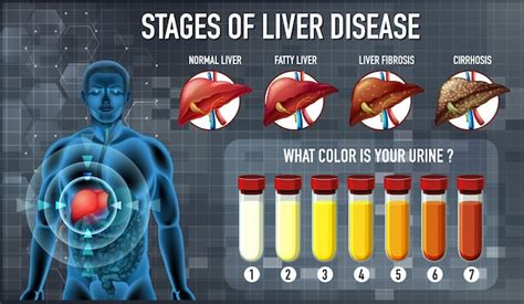 Liver Cancer Types And Stages