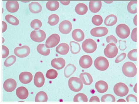 Dimorphic anemia. Anisocytosis and anisochromia characterized by the ...