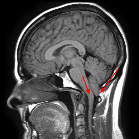 Chiari Malformation - Causes, Symptoms, Prognosis, Diagnosis, Treatment