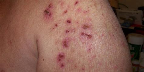 Morgellons Disease Causes, Signs and Symptoms