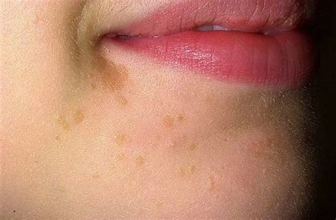 Flat Warts: Symptoms, Causes, and Ways of Treatment - Med Warts