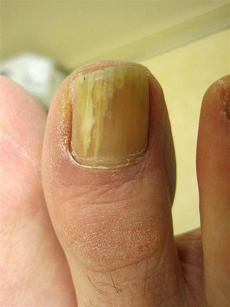 Yellow toenails and diabetes - Awesome Nail