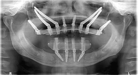 Zygomatic Implants Athens, Buckhead, Conyers, Snellville GA | Rescue ...