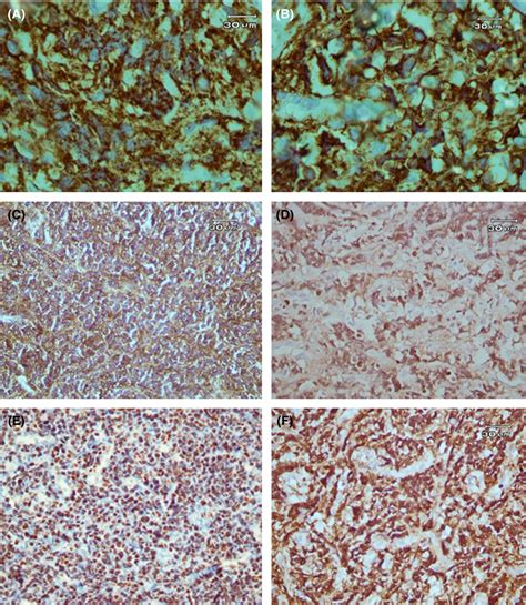 Immunohistochemistry sections. (A) CD20 positive staining of B cells ...