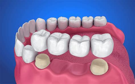 Types of Dental Bridges