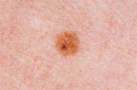 Junctional naevus (mole) on the skin - Stock Image - C013/0890 - Science Photo Library